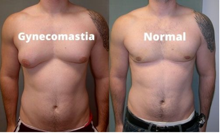 Gynecomastia Effective Treatments Of Gynecomastia